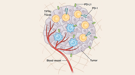【前沿进展】抗肿瘤黑科技——TIL细胞疗法