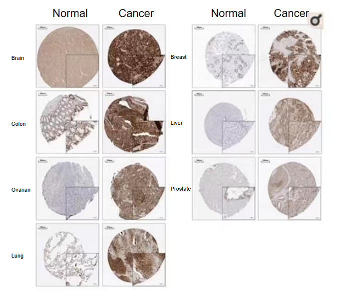 TFR在多个肿瘤中的表达