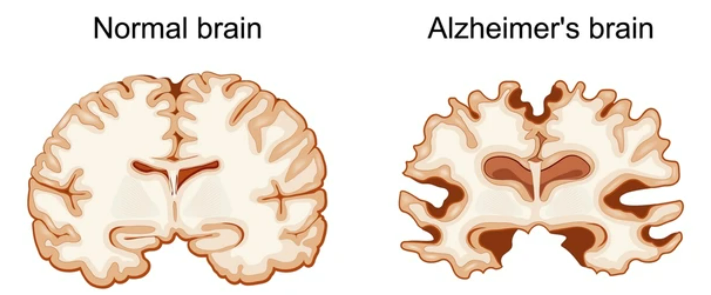 正常及AD患者脑部结构示意图