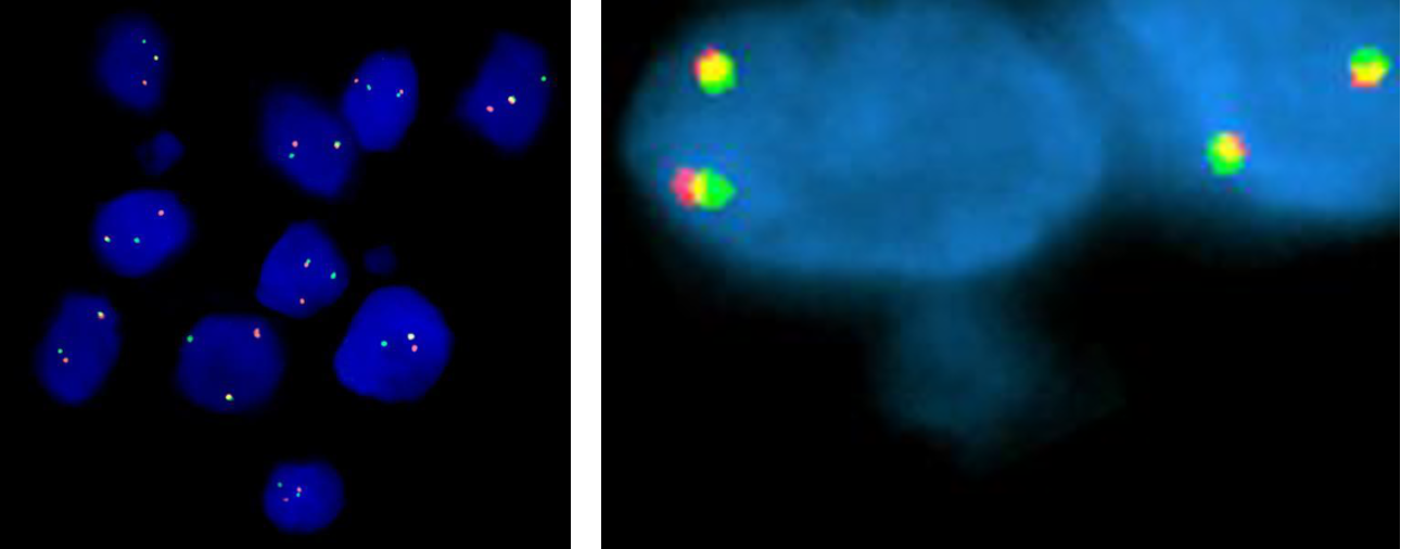 百普赛斯病理试验室ALK的FISH染色结果