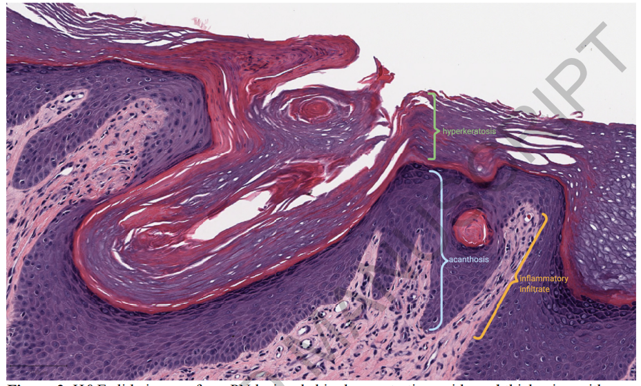 PN病变皮肤的HE切片图像显示表皮增厚，伴有角化过度、棘层增厚和显著的炎症浸润