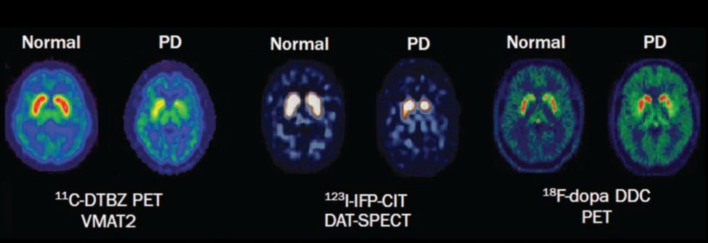 通过PET和SPECT技术非侵入性地可视化PD患者的纹状体退化